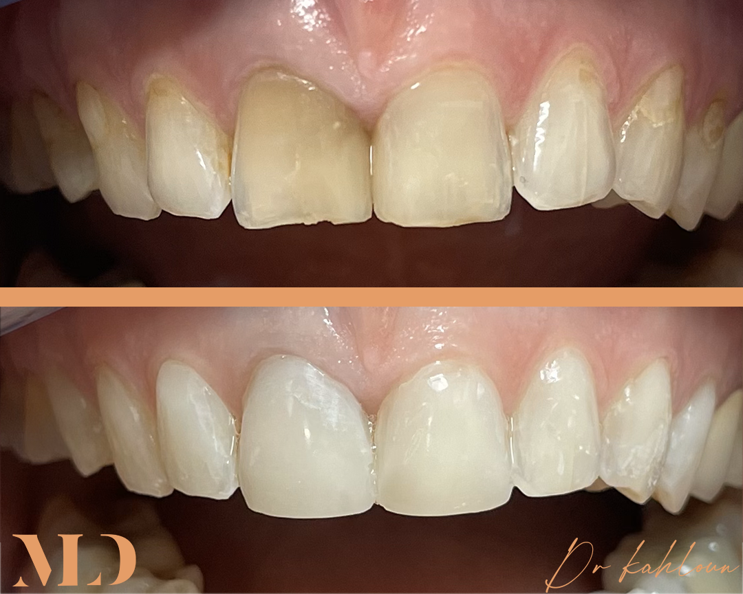 instagram Restaurations composites antérieurs