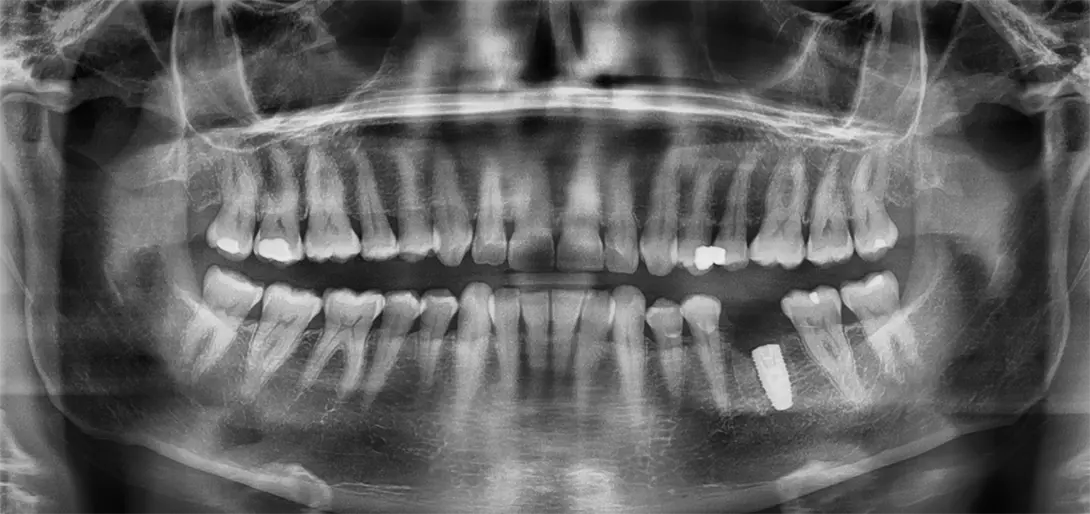 Implants-dentaires-maisons-laffitte